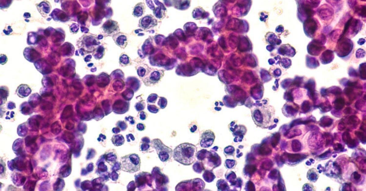FlipFact (February 4, 2020): How many types of cancer are there?