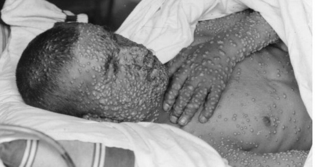 flipfact, flipfacts, flipscience, smallpox, vaccine, vaccines